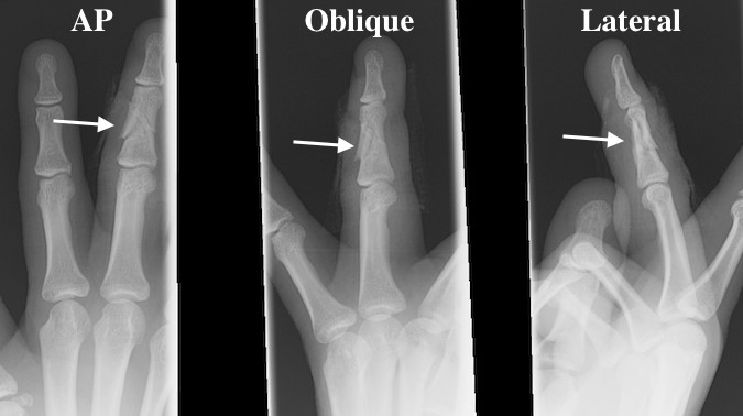 Finger Middle Phalanx Adult Hand Surgery Resource